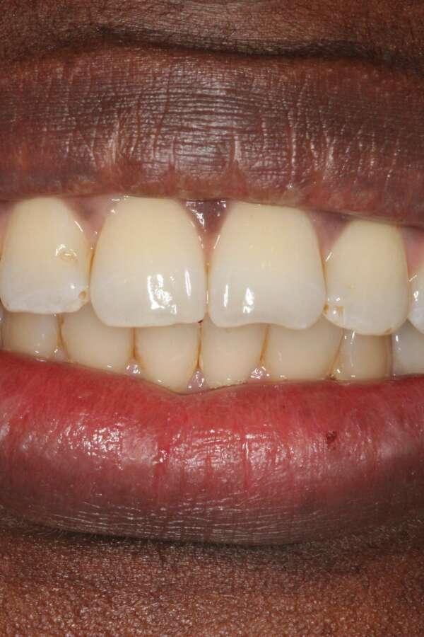 Lingual Braces After 6