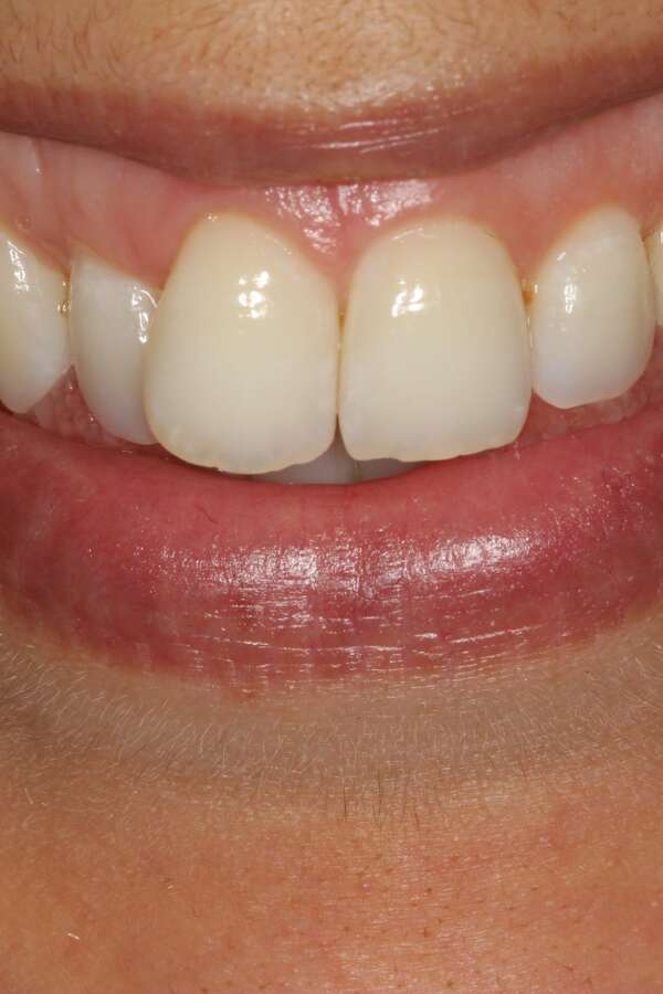 Lingual Braces Before 1