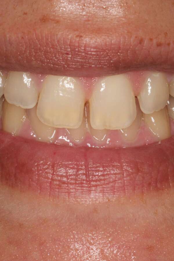 Lingual Braces Before 2