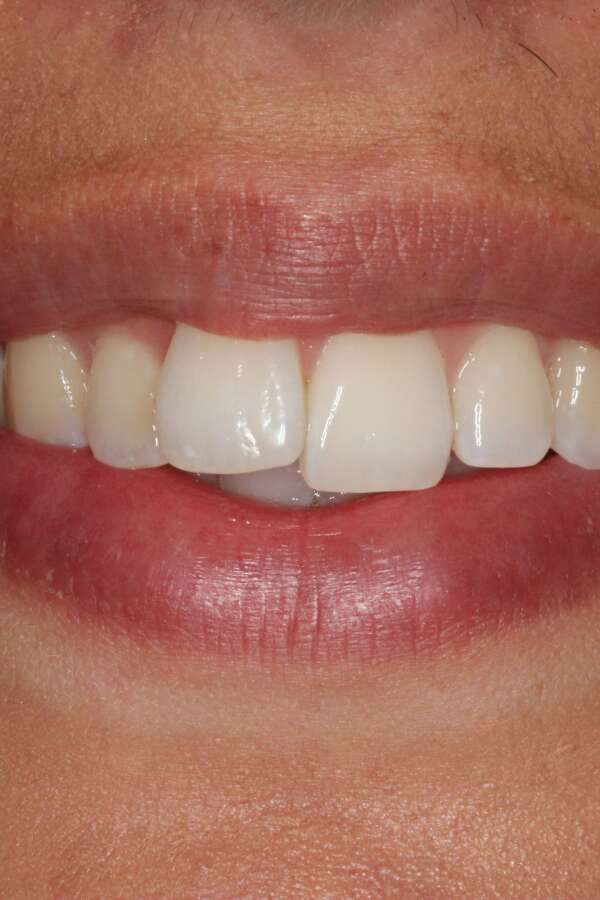 Lingual Braces Before 3