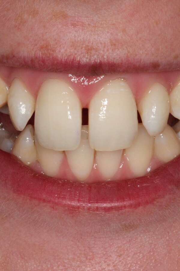 Lingual Braces Before 4