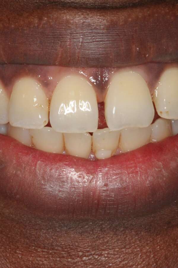 Lingual Braces Before 6