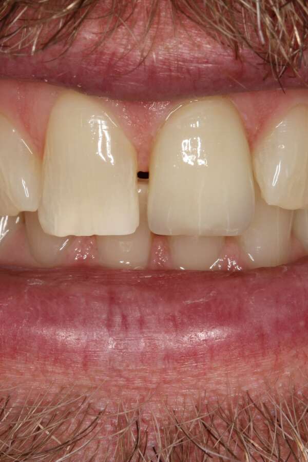 Porcelain veneers After 5