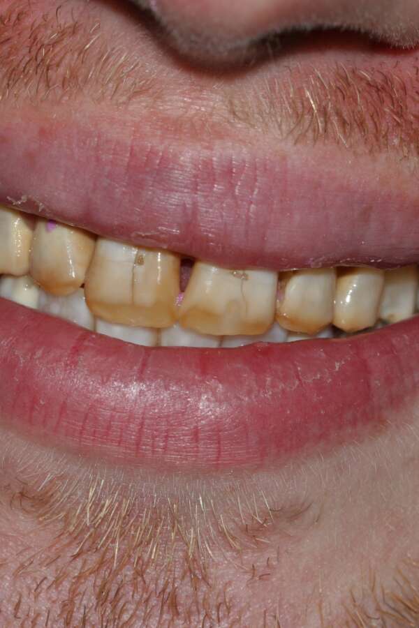 Porcelain veneers Before 6