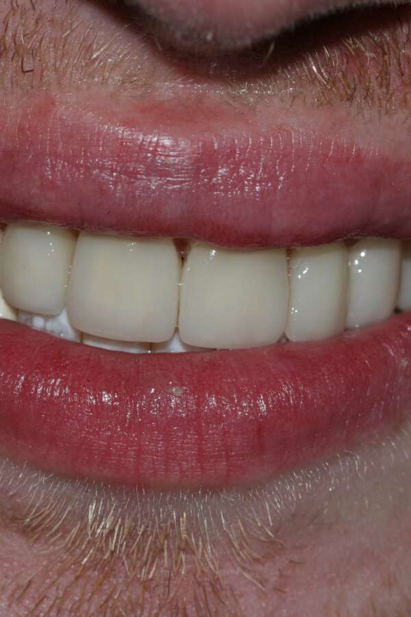 Porcelain veneers After 6