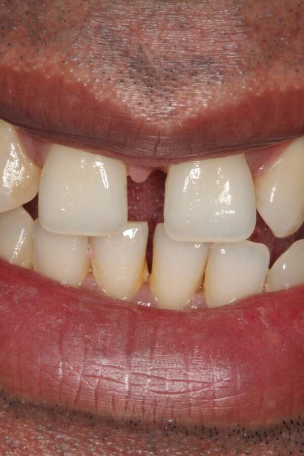 Porcelain veneers Before 1