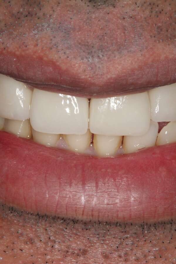 Porcelain veneers After 1