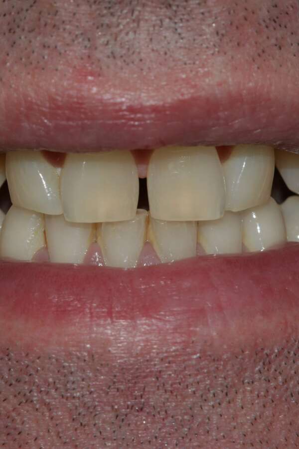 Porcelain veneers Before 2