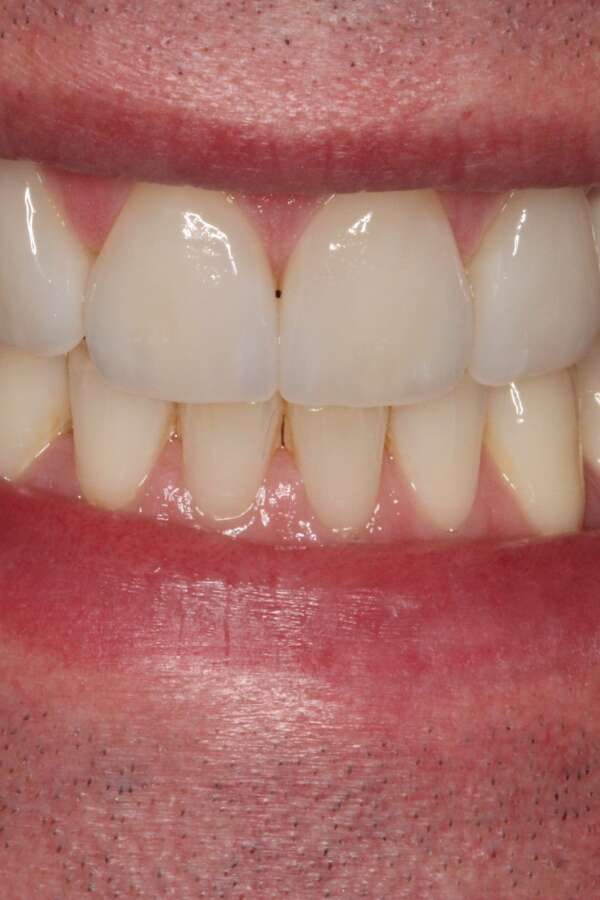 Porcelain veneers After 2