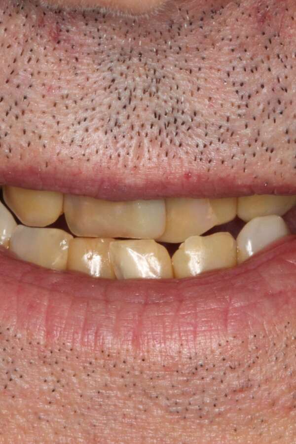 Porcelain veneers Before 3