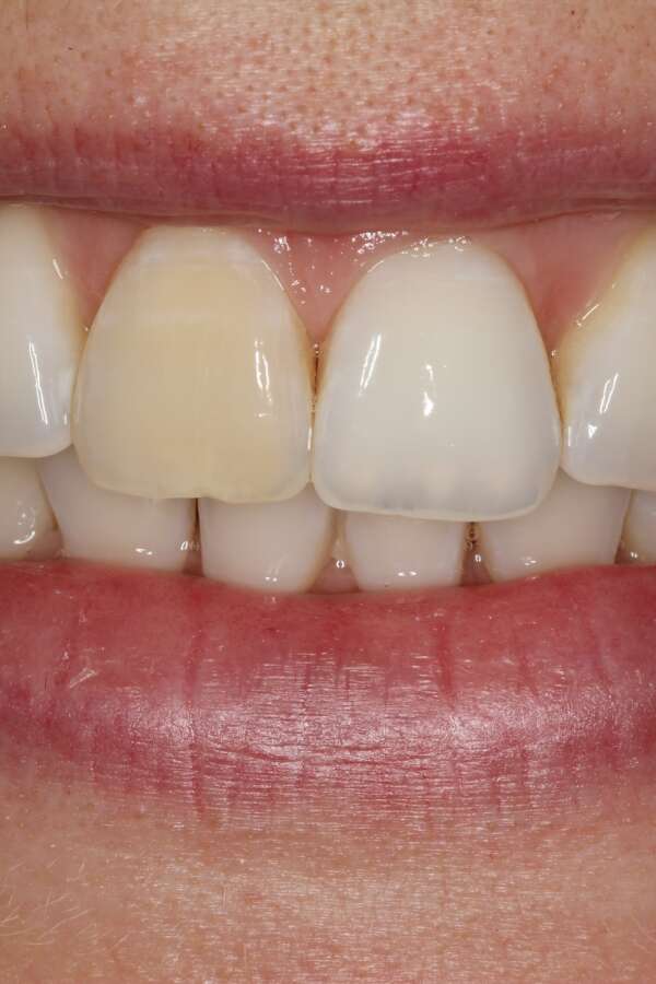 Porcelain veneers Before 4