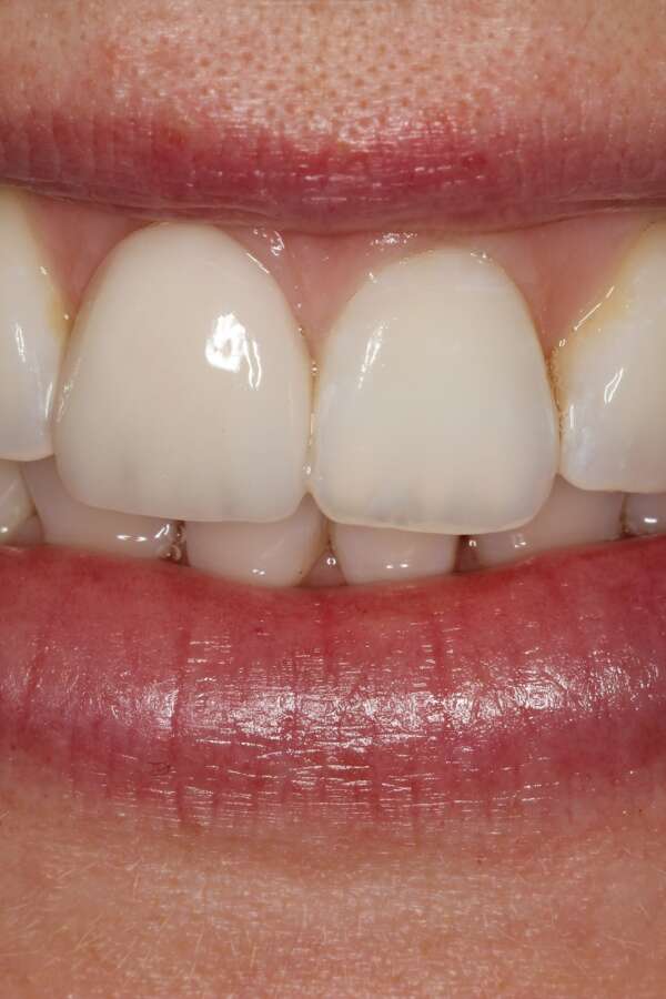 Porcelain veneers After 4