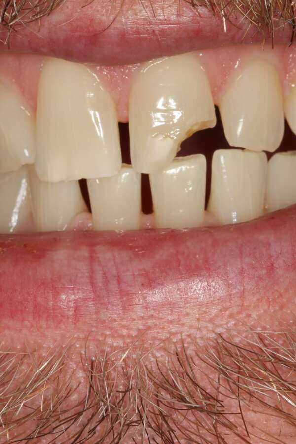 Porcelain veneers Before 5