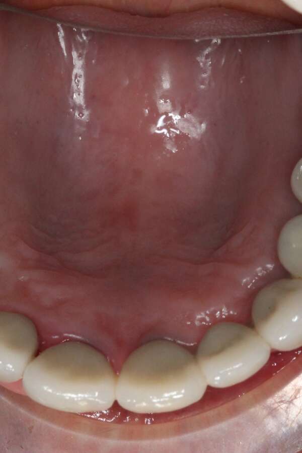 Several teeth implants After 5