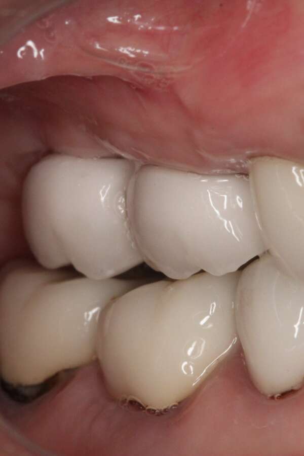 Several teeth implants After 1