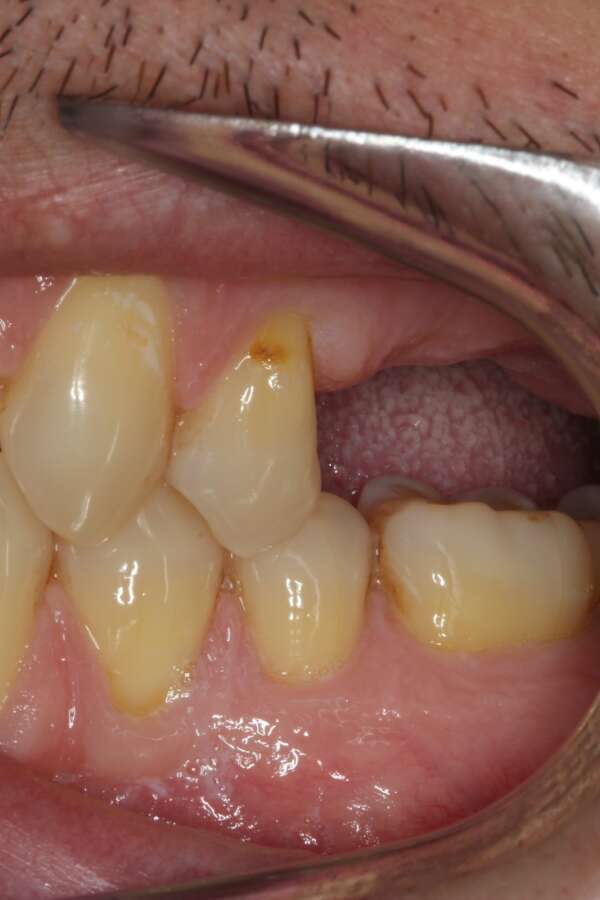 Several teeth implants Before 2
