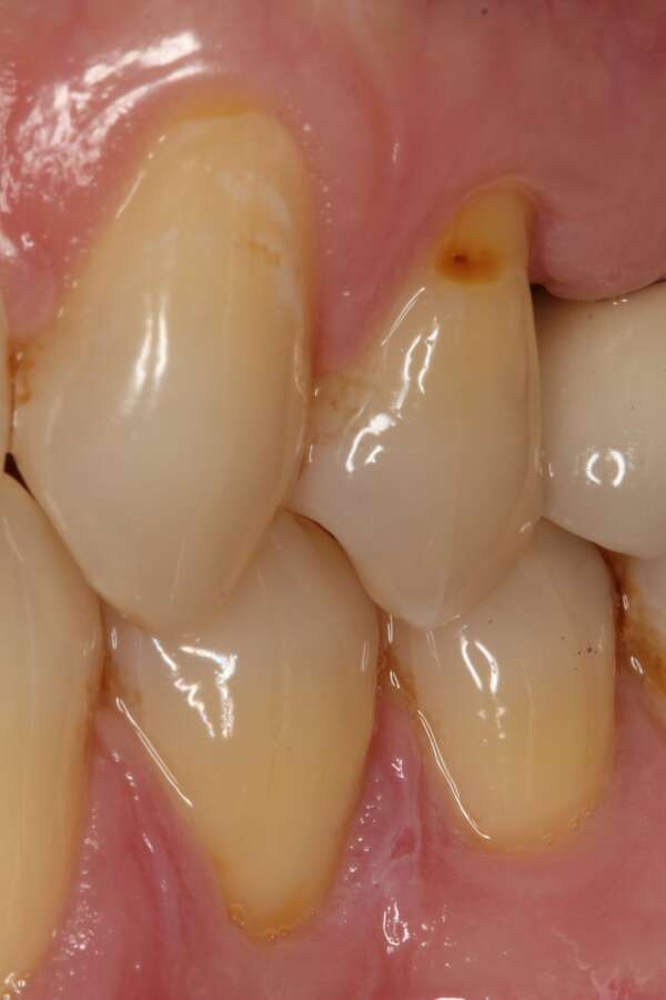 Several teeth implants After 2