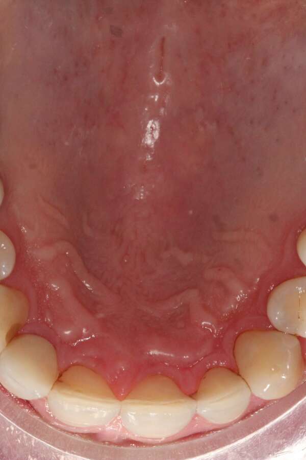 Several teeth implants After 3