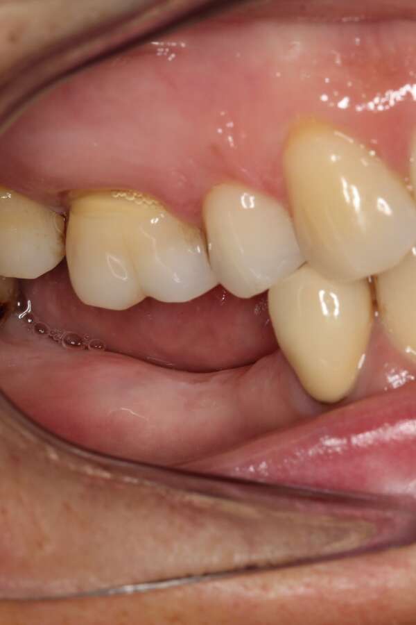 Several teeth implants Before 4