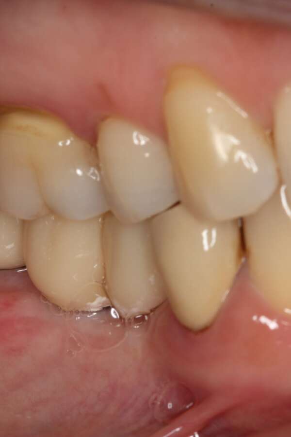 Several teeth implants After 4