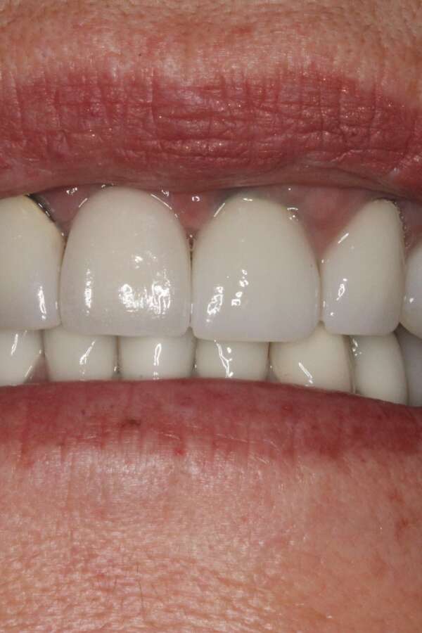 Single tooth implant After 5