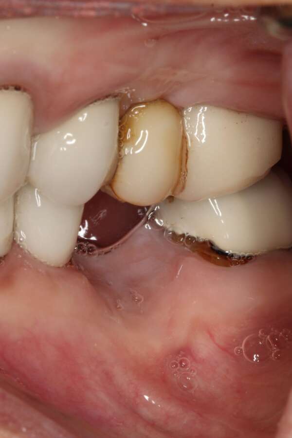 Single tooth implant Before 6
