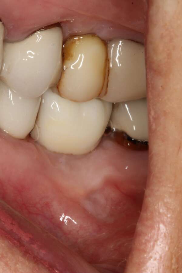 Single tooth implant After 6