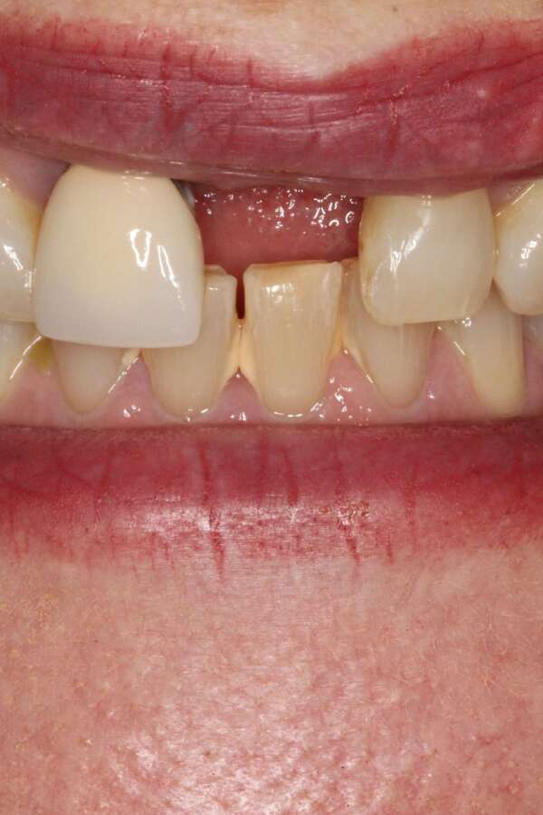 Single tooth implant Before 7