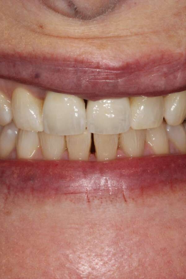 Single tooth implant After 7