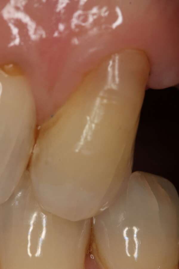 Single tooth implant Before 1