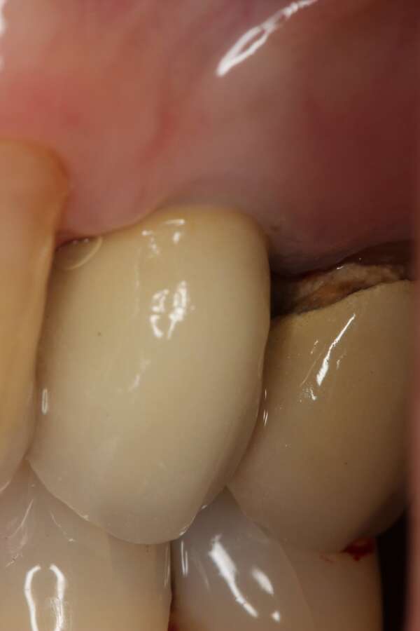 Single tooth implant After 1