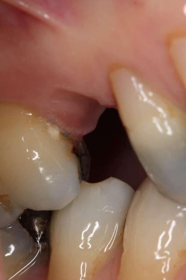Single tooth implant Before 2