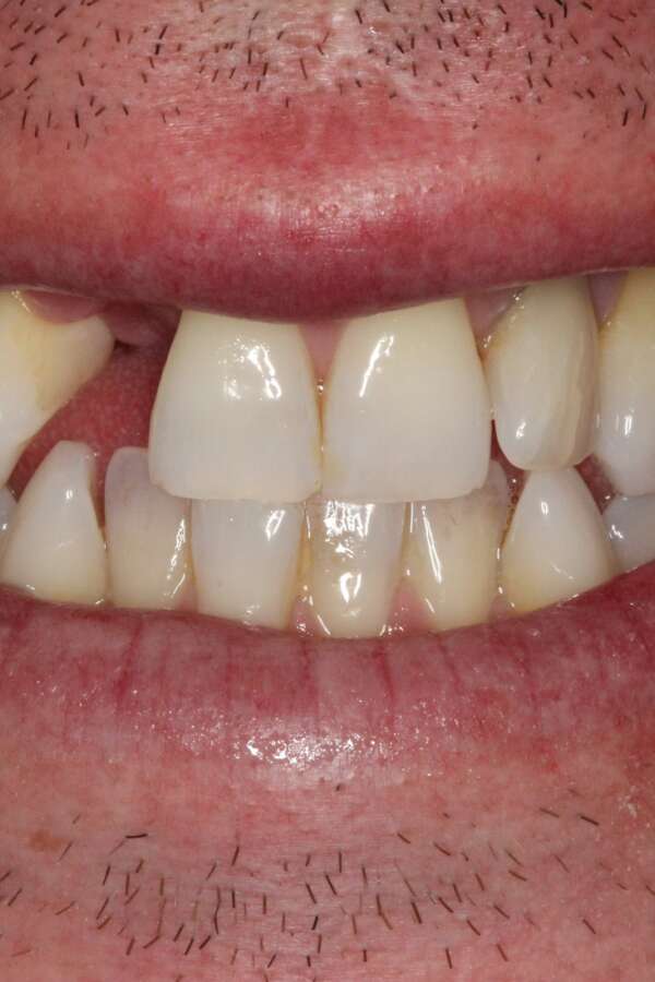 Single tooth implant Before 3