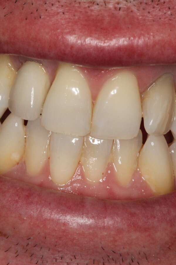 Single tooth implant After 3