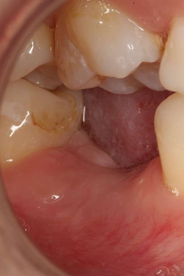 Single tooth implant Before 4