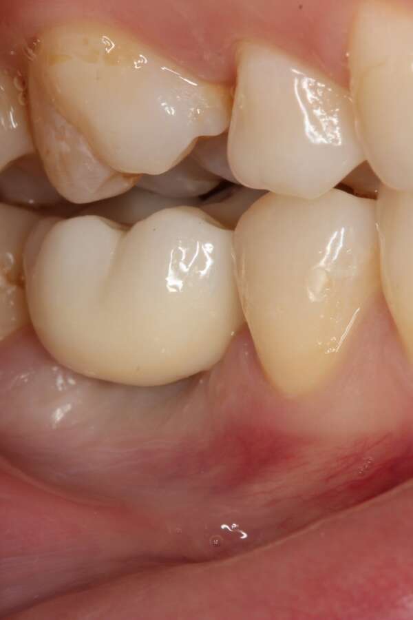 Single tooth implant After 4