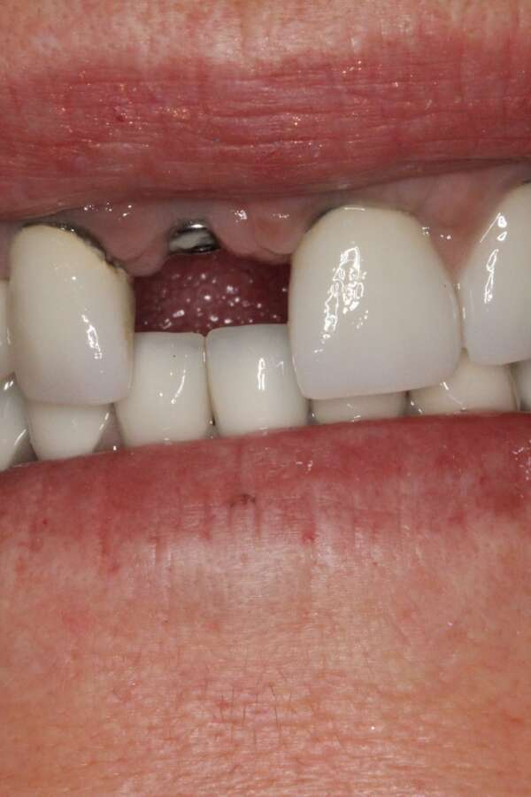 Single tooth implant Before 5