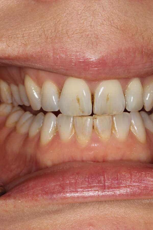 Tooth whitening Before 1