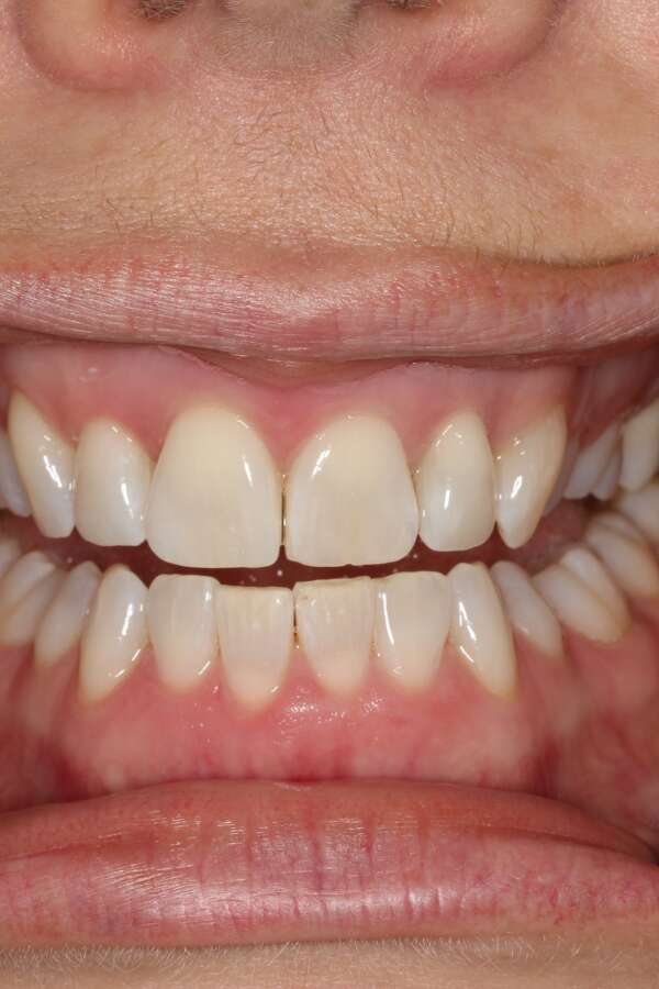 Tooth whitening After 1