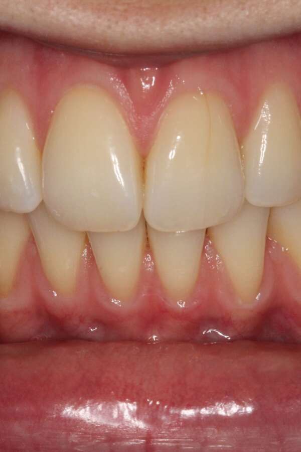 Tooth whitening Before 2