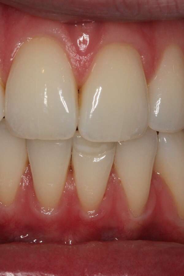 Tooth whitening After 2
