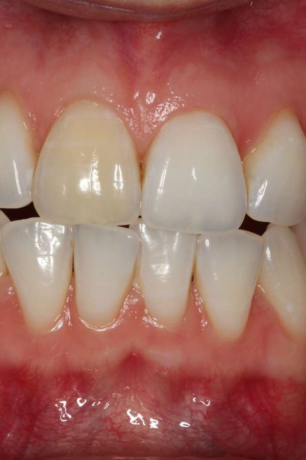 Tooth whitening Before 3