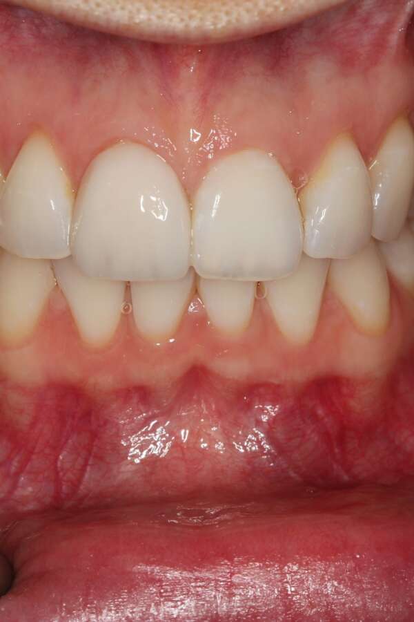 Tooth whitening After 3