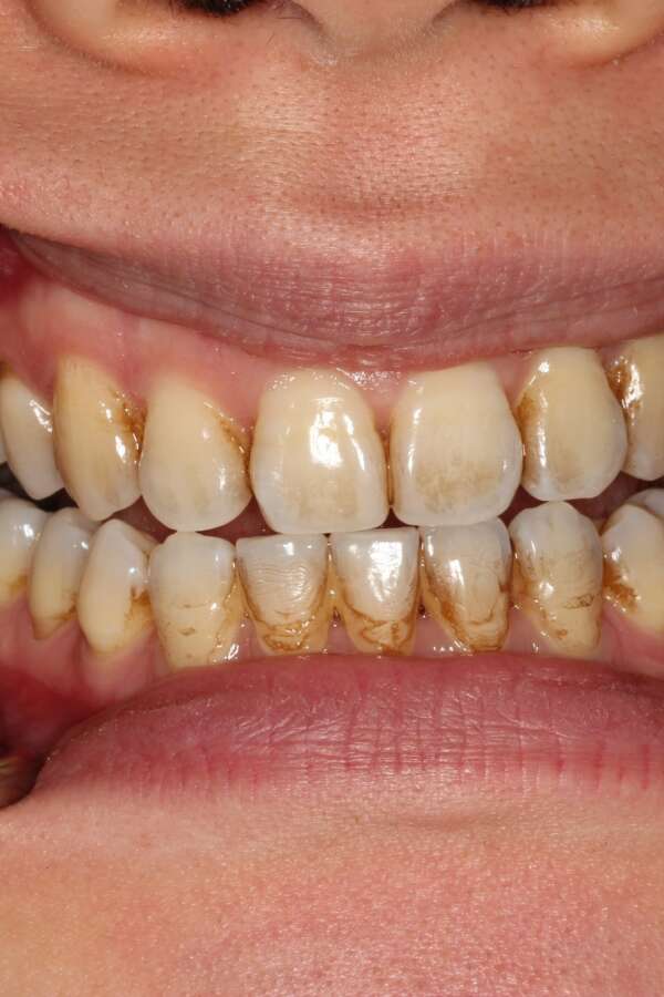 Tooth whitening Before 4