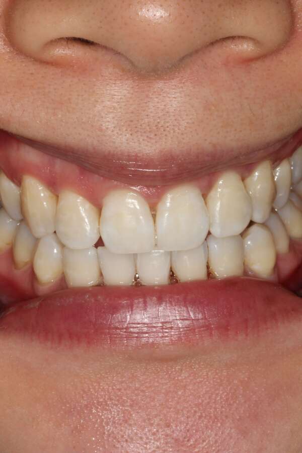 Tooth whitening After 4