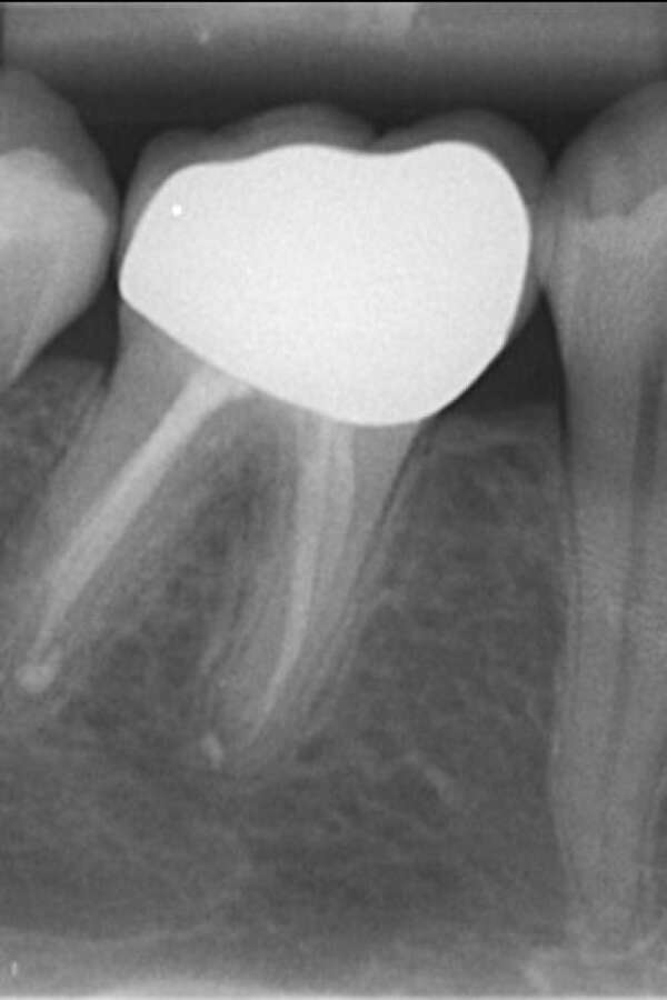 after root canal treatment