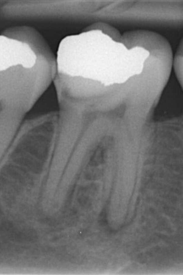 before root canal treatment