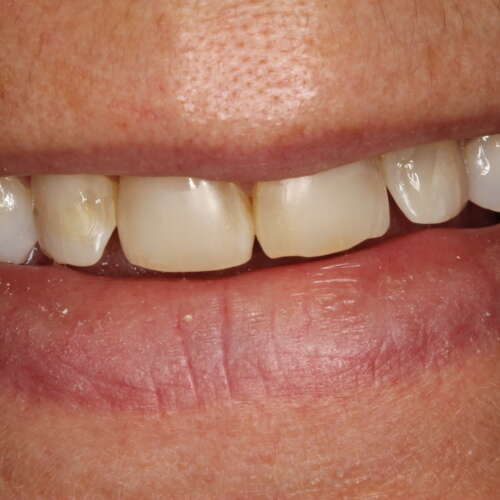 Minimally invasive veneers
