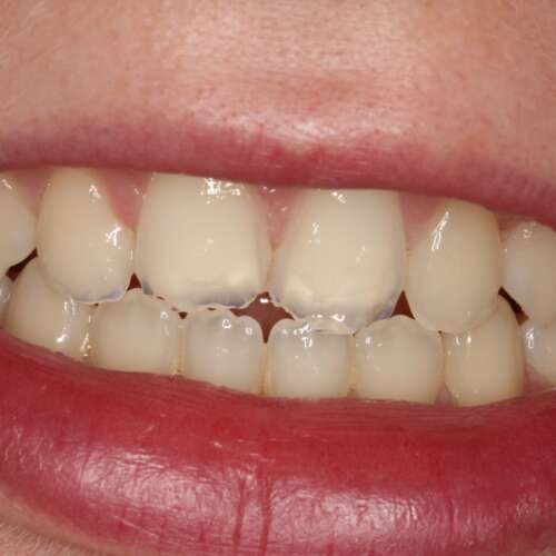 teeth with severe tooth wear