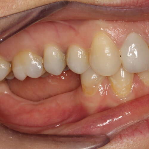 most of the teeth on the lower right side missing